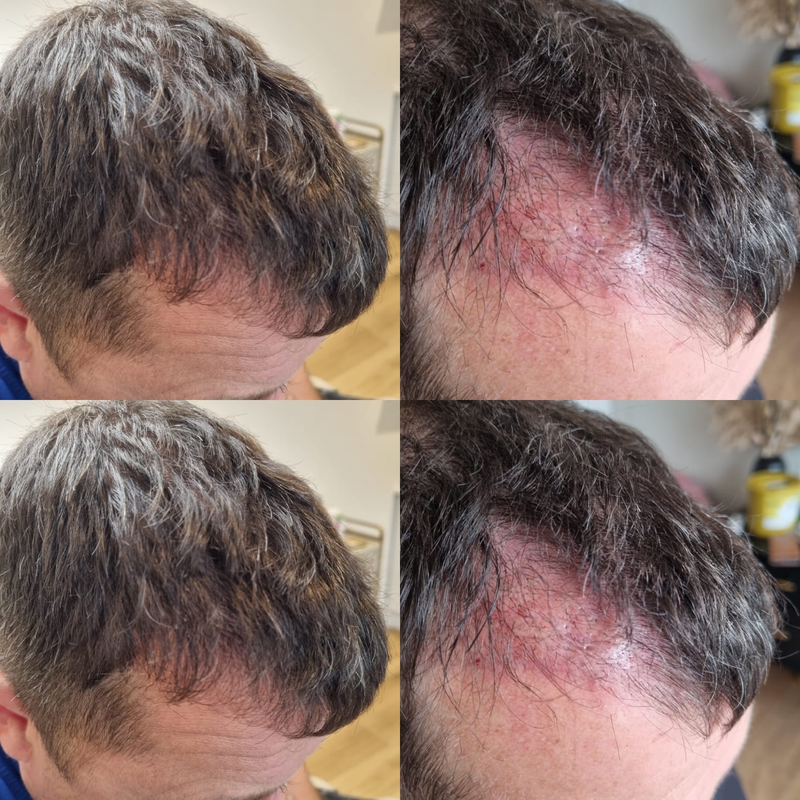 PRP-Hair-Treatment