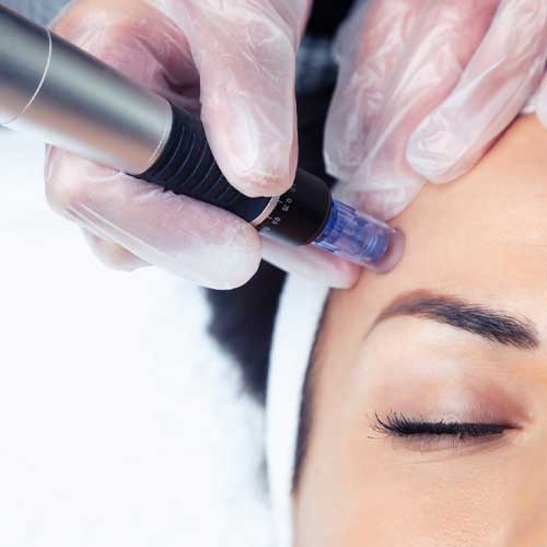 Microneedling treatment
